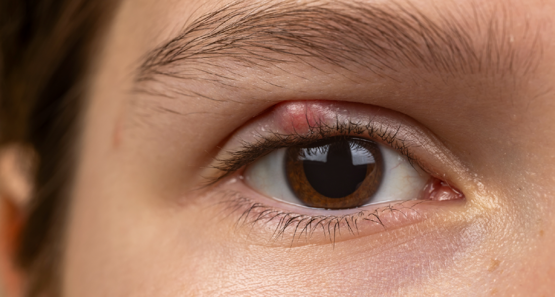 diagnóstico de blefaritis