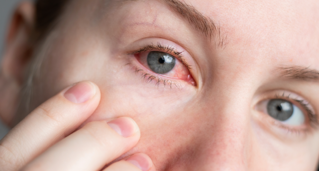 síntomas y tratamiento de la conjuntivitis