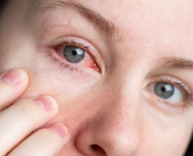 conjuntivitis alérgica