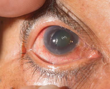 generalidades de glaucoma