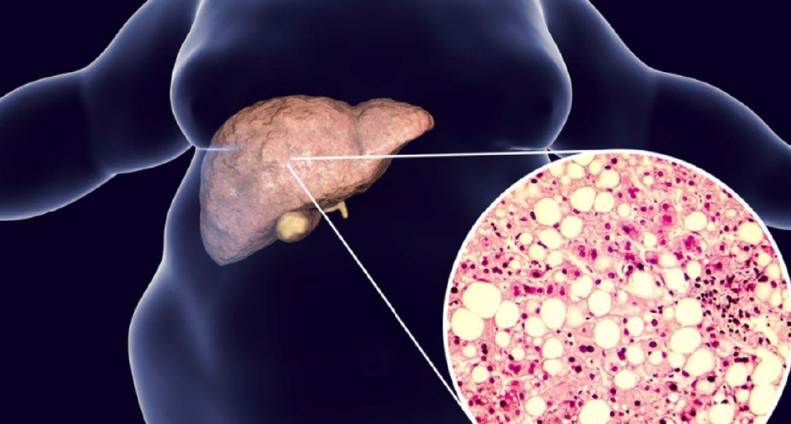 esteatohepatitis diagnóstico y tratamiento