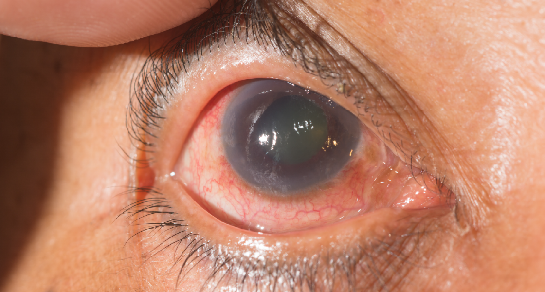 generalidades sobre el glaucoma