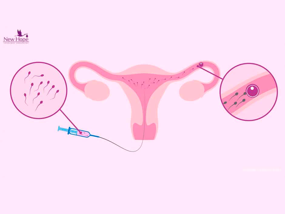 Inseminación intrauterina